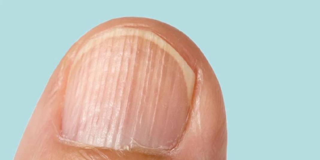 Vitamin eksikliği sandığınız çizgiler ipucu olabilir! Vitamin eksikliği mi, başka bir sorun mu? İşte cevabı… 4